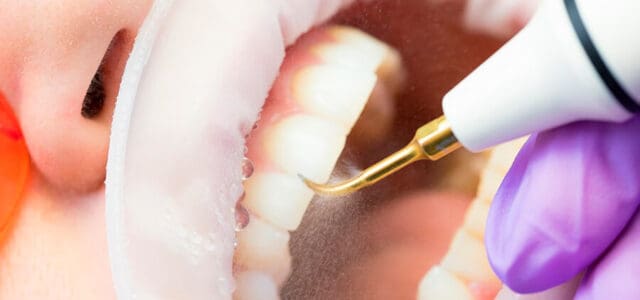higiene dental profesional