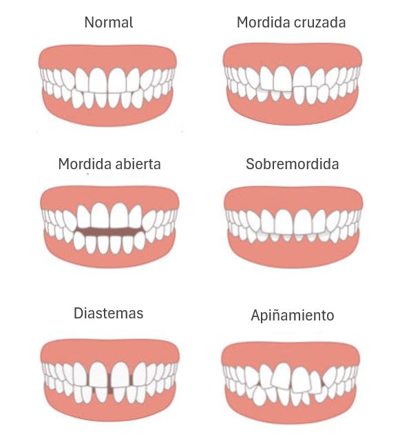 tipo maloclusiones ortodoncia