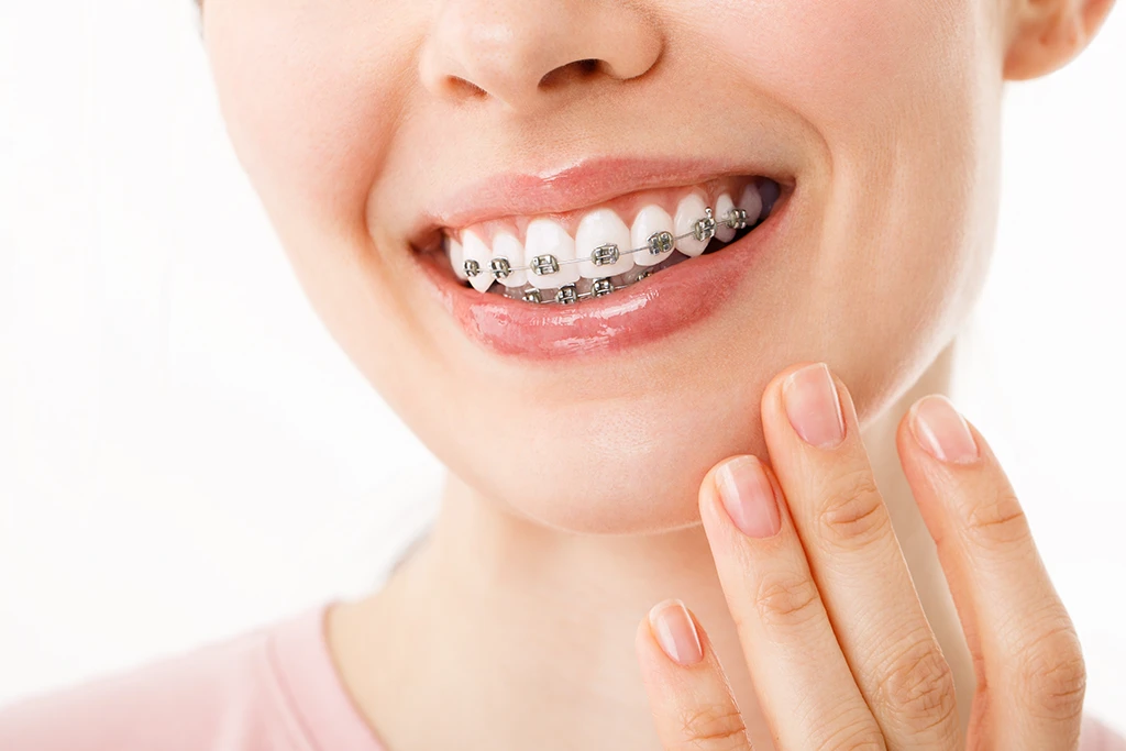 brackets ortodoncia sants